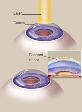 grafico dell'occhio e dell'intervento