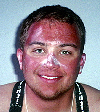 scttatura solare sunburn